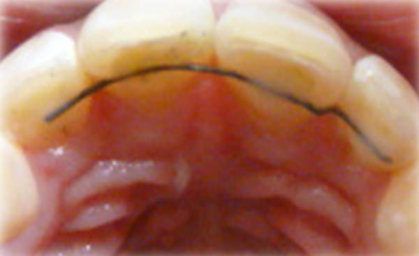 Figura 18 Intraoral oclusal superior