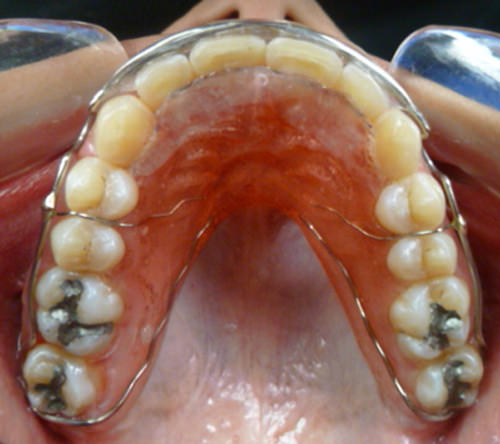 Figura 20 Intraoral oclusal superior