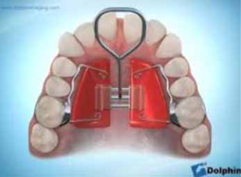 Figura 5 Imagen de expansor tipo Hass.