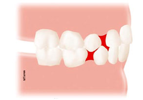 Fig. 1 Espacio primate. Carvajal, M. Desarrollo de la dentición. La dentición primaria. Revista Latinoamericana de Ortodoncia y Odontopediatria 2009.