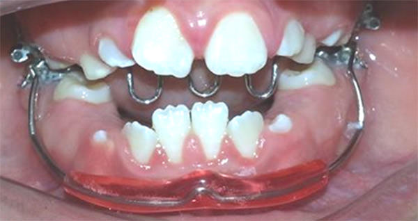 Fig. 2 Lip Bumper. Paciente de la Facultad de Odontología, Universidad de Cuenca 2014