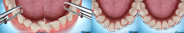 Fig. 3 Desgaste Interproximal. Bronsky, M.