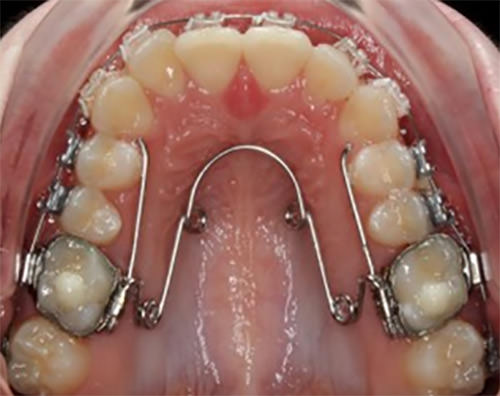 Fig. 4 Quadhelix Swart, R. Quad Helix Expansion. Orthodontic Practice 2014