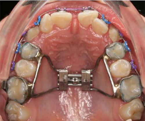 Fig. 5 Quadhelix Swart, R. Rapid palatal expansion - full fixed appliances. Orthodontic Practice 2014