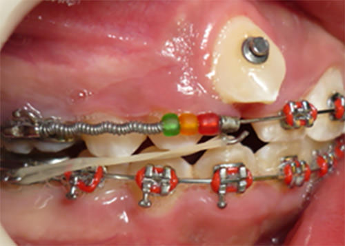 Fig. 6 Sliding Hook. Rodriguez, M. et al. Distalización de molares superiores en maloclusión clase II dento alveolar severa, sin extracciones, tratamiento con Sliding Hook.
