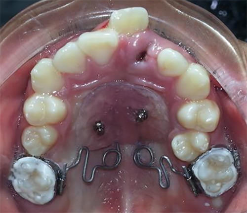 Fig. 8 Péndulo Óseo Soportado. Paciente de la Facultad de Odontología, Universidad de Cuenca