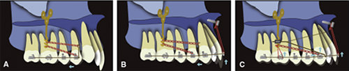 Fig 3. Nishimura et al Nonextraction treatment with temporary skeletal anchorage devices to correct a Class II Division 2 malocclusion with excessive gingival display (Am J Orthod dentofacial Orthop 2014; 145:85-94)