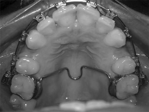 Fig. 3 Barra palatina, sistema de anclaje convencional, en casos de extracción de premolares. Tomado de Salma Al-Sibaie (2014) Randomized Controlled Trial Assessment of changes following en-masse retraction with mini-implants anchorage compared to two-step retraction with conventional anchorage in patients with class II division 1 malocclusion: a randomized controlled trial. European Journal of Orthodontics 36 doi:10.1093/ejo/cjt046275-283