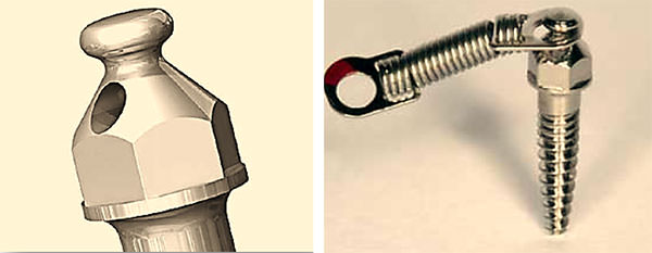 Fig. 4 A. Detalle de una cabeza del minimplante, debidamente dimensionado para la fijación del resorte de Nitinol B. Resorte de Nitinol fijado a la cabeza del minimplante. Tomado de Marassi C., Marassi C.: (2008) Mini-implant assisted anterior retraction. Dental Press J. Orthod. v. 13, no. 5, p. 57-74