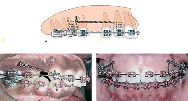 Figura 5 A, Diferentes posiciones del microimplante y diferentes posiciones del brazo de poder. B, Vector de intrusión. C, Vector de extrusión. (Tomado de Marassi C., Marassi C.: (2008) Mini-implant assisted anterior retraction. Dental Press J. Orthod. v. 13, no. 5, p. 57-74)