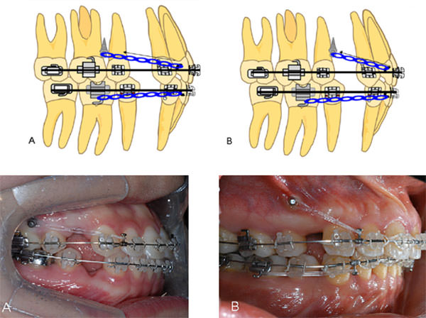 Figura 6 Esquema y fotografías intraorales: Grupo A: utilizaron un microimplante entre el premolar y el molar, y grupo B: utilizaron el microimplante entre los premolares (mesial de segundo premolar), Tomado de Kee-Joon Lee et al (2011) Displacement pattern of the maxillary arch depending on miniscrew position in sliding mechanics Am J Orthod Dentofacial Orthop; 140:224-32