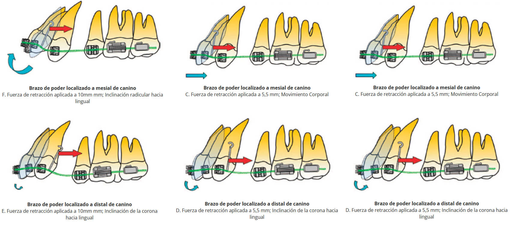 Figura 7 Ubicación del brazo de poder, a mesial del canino a distal del canino y en diferentes alturas, para la mecánica de deslizamiento. Tomado de Jun-ya Tominagaa., Motohiro Tanakab., Yoshiyuki Kogac., Carmen Gonzalesa., Masaru Kobayashid., Noriaki Yoshidae .: (2009) Optimal Loading Conditions for Controlled Movement of Anterior Teeth in Sliding Mechanics Angle Orthod.;79:1102-1107.)