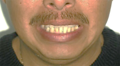 Figura 1 Frente sonrisa