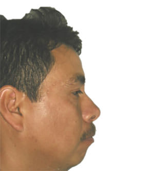 Figura 2 Paciente de perfil