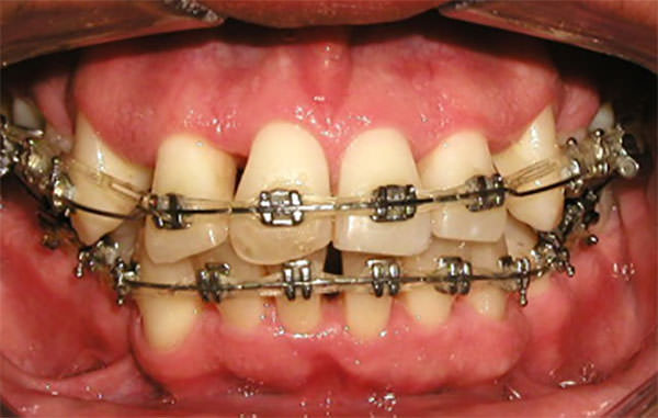 Figura 8 Intraoral de frente de progreso