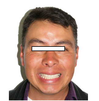 Fig. 10 Extraoral de frente de sonrisa