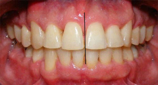 Fig 12 Intraoral de frente final.