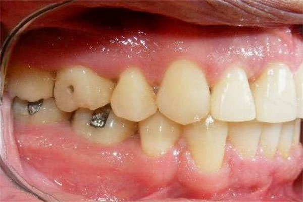 Fig 13 Intraoral lateral derecha sin el 1er premolar