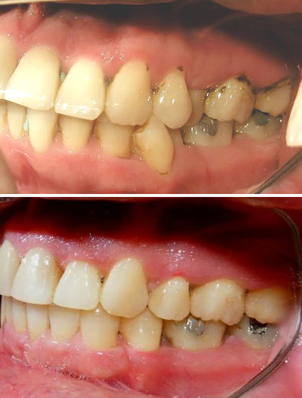 Fig 14 Lateral izquierda inicio y final sin el 1er premolar