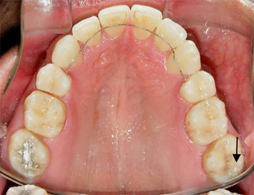 Fig. 17 Retenedor fijo superior de 5 a 5 