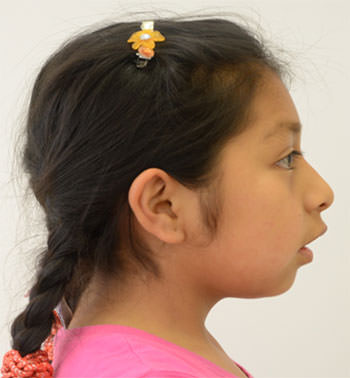 Figura 4 Características faciales paciente clase II/1