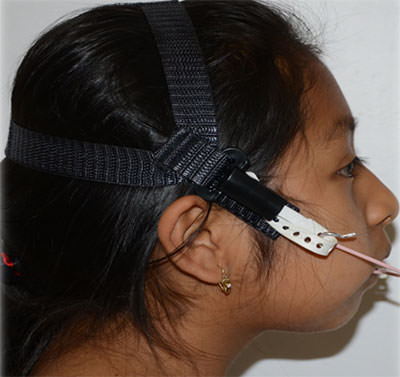 Figura 4 Fuerzas extraorales para corrección de clase II y mordida abierta