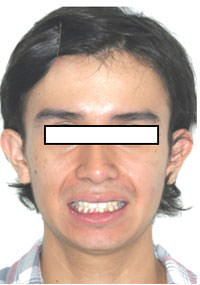 Fig. 3 Sonrisa