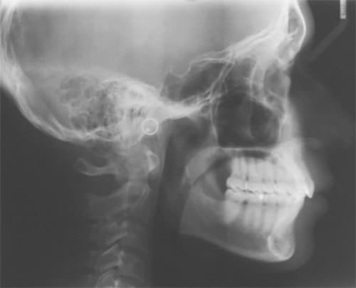 Fig . 4 Radiografia lateral de craneo. 