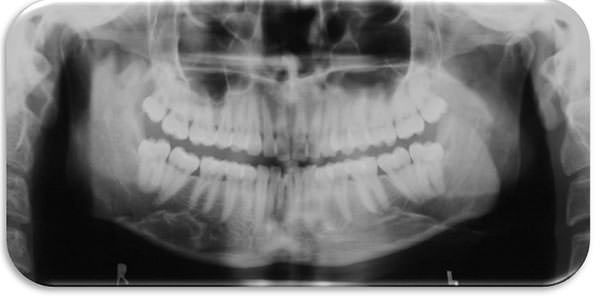 Fig. 5 Radiografia panoramica inicial