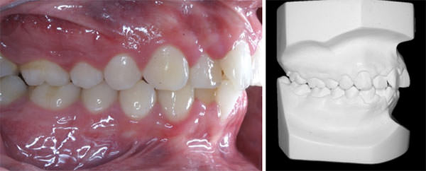 Fig. 6 Lateral derecha y de modelos de estudio derecho inciales. 