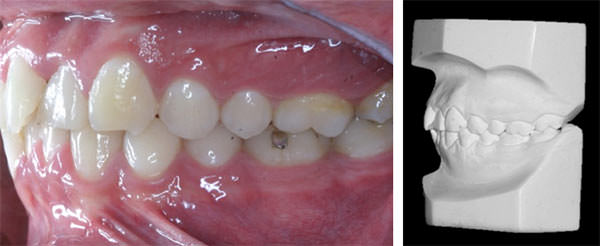 Fig. 7 Lateral izquierda y de modelos izquierdo iniciales.