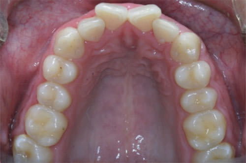 Fig. 8 Oclusal superior de inicio