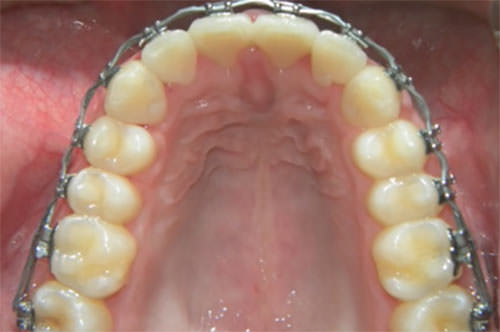 Fig. 12 Oclusal superior