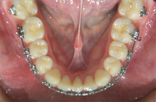 Fig. 13 Clusal inferior