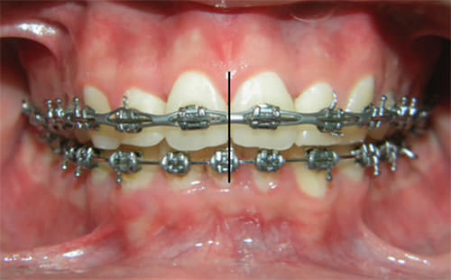 Fig. 14 Intraoral de frente