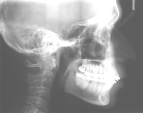Fig. 17 Radiografia lateral de craneo