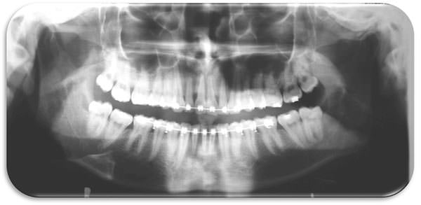 Fig. 18 Radiografia panoramica