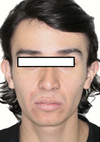 Fig. 19 Fente final