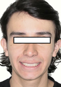 Fig. 21 Sonrisa