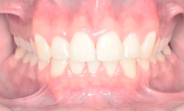 Fig. 22 Intraoral de frente final