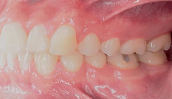 Fig. 25 Lateral izquierda final