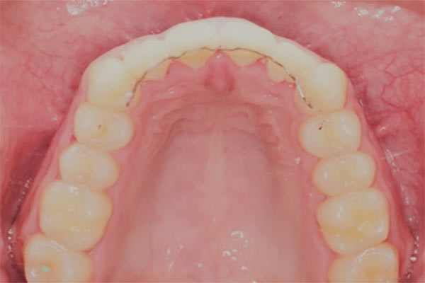 Fig.26 Oclusal superior final