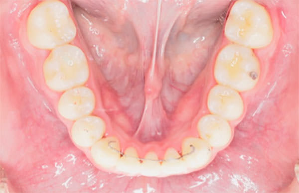 Fig.27 Oclusal inferior