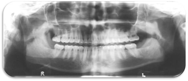 Fig. 28 Radiografía panorámica final