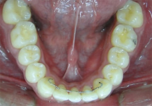 Fig.29 Oclusal con retenedor