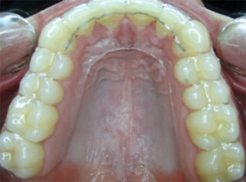Fig. 30 Oclusal inferior con retenedor