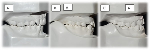 Figura 1 Clasificación de Angle. a) Clase I molar, b) Clase II molar, c) Clase III molar. Pacientes de la Facultad de Odontología, Posgrado de Ortodoncia, Universidad de Cuenca.