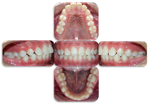 Figura 3 Clase I molar bilateral y apiñamiento anteroinferior. Paciente de la facultad de Odontología, Posgrado de Ortodoncia, Universidad de Cuenca.