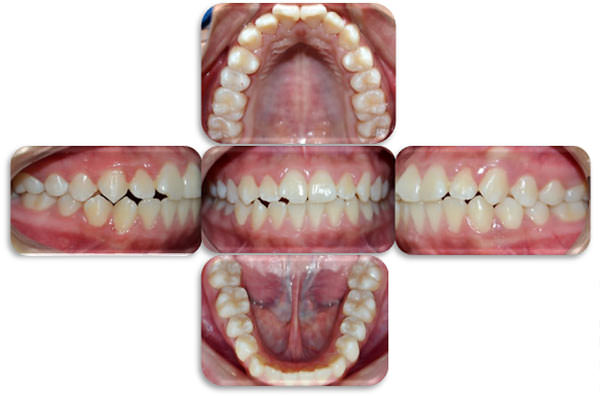 Figura 4 Clase I molar bilateral, incisivos protruidos debido a hábito de deglución atípica. Paciente de la facultad de Odontología, Posgrado de Ortodoncia, Universidad de Cuenca. 