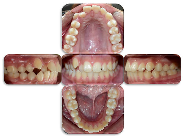Figura 5 Clase I molar bilateral, Mordida cruzada entre las pz 12 y 42. Paciente de la facultad de Odontología, Posgrado de Ortodoncia, Universidad de Cuenca. 